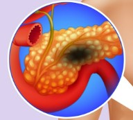 pancreatic image