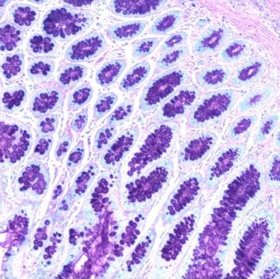 colon cancer image