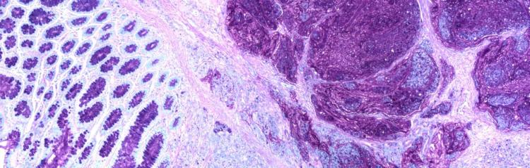 A colon cancer tissue scan