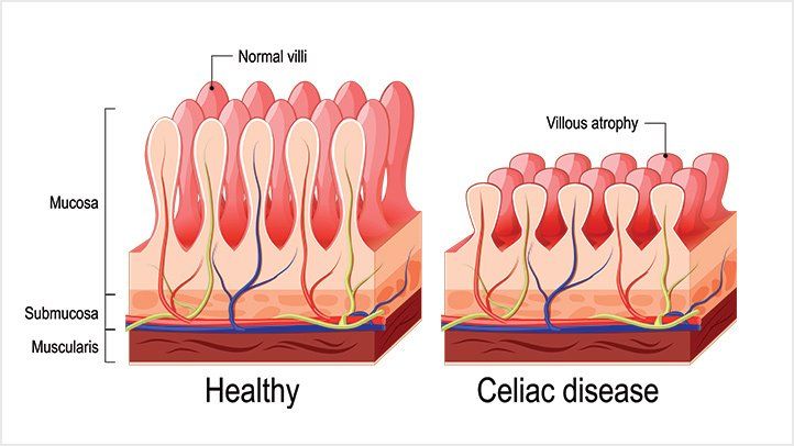 celiac