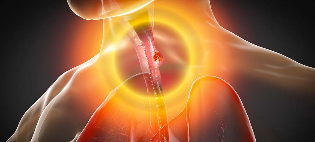 esophagitis image