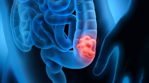 colorectal image